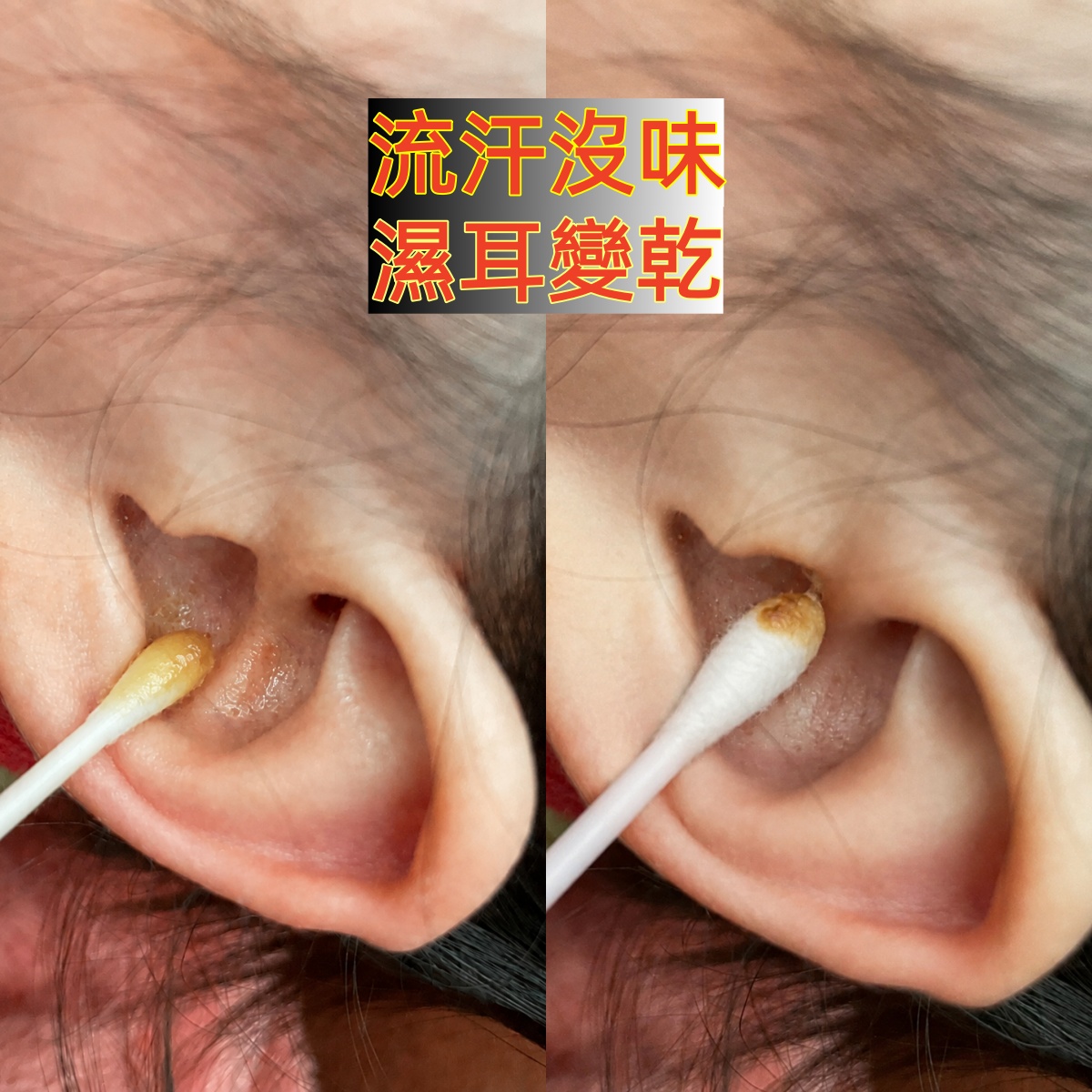濕耳垢狀態參考
